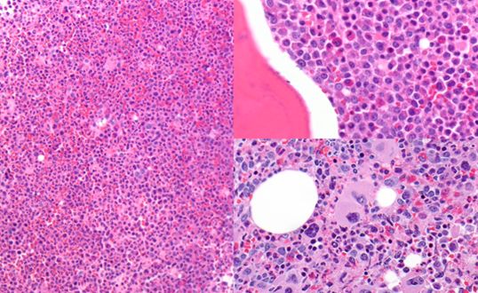 CML: t(9;22) BCR-ABL1 creates the Philadelphia chromosome. TKI therapy (imatinib) has transformed prognosis.